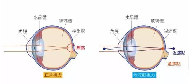 白內(nèi)障和老花眼區(qū)別，老花眼發(fā)病率正呈現(xiàn)年輕化趨勢