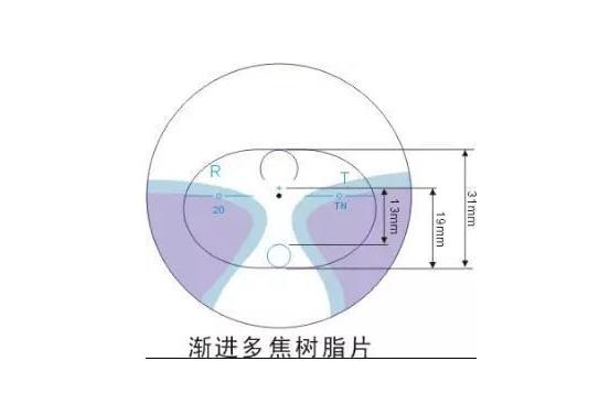美麗島多焦鏡適合的人群，需要注意的事項(xiàng)